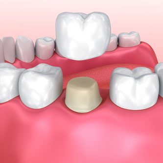 Dental-Crown-1