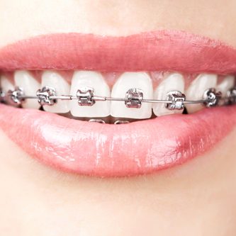 Traditional-Braces