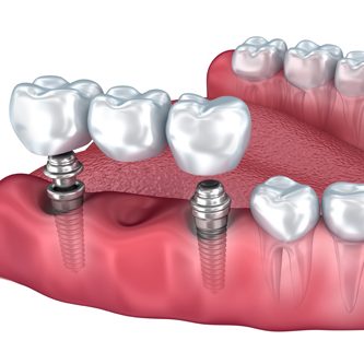 dental-bridges4