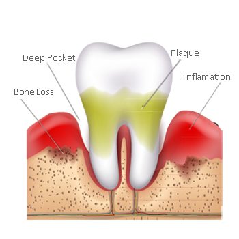 periodontis-2