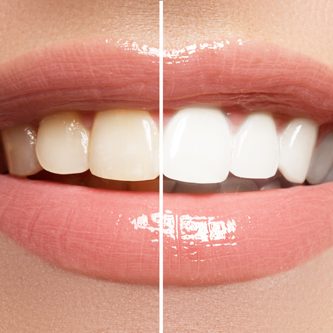 whitening-1